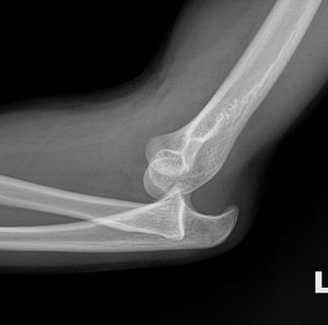 Elbow Dislocation - 肘关节脱臼